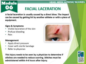 Facial Laceration – National Center for Sports Safety