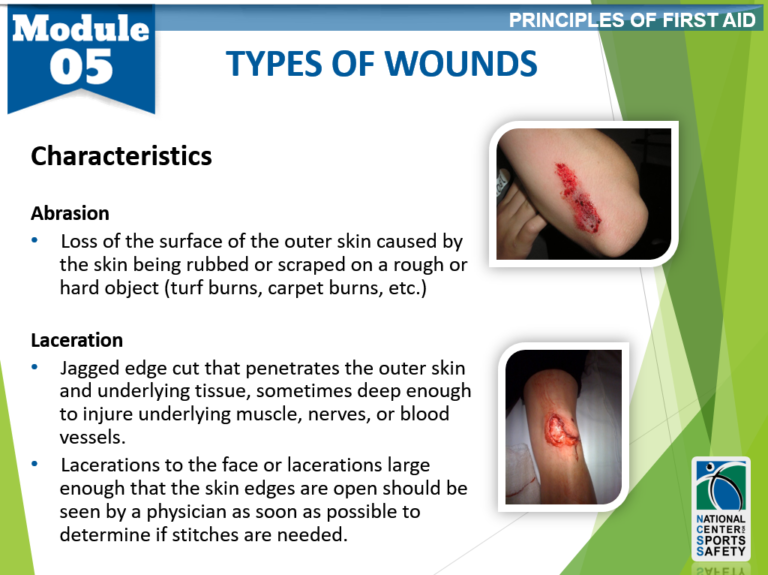 Types Of Wounds Pt 2 National Center For Sports Safety